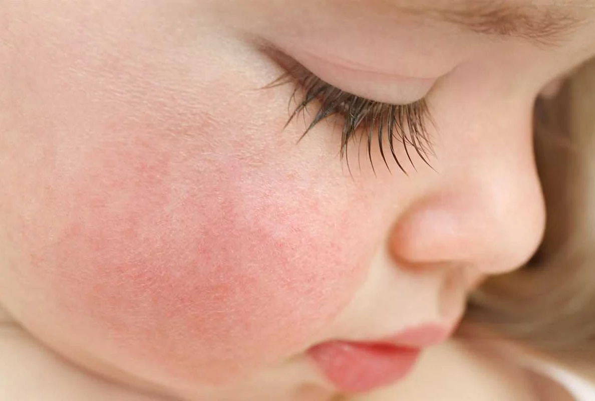 Народные методы лечения аллергии у ребенка