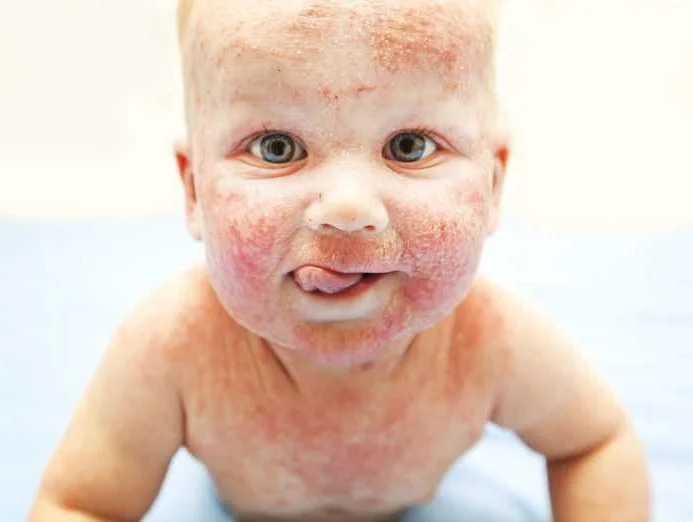 Пищевая аллергия у ребенка 6 лет