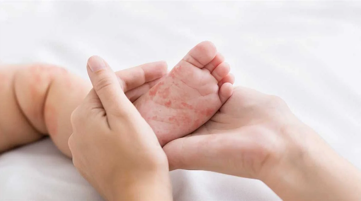 Профилактика аллергии у ребенка 6 лет
