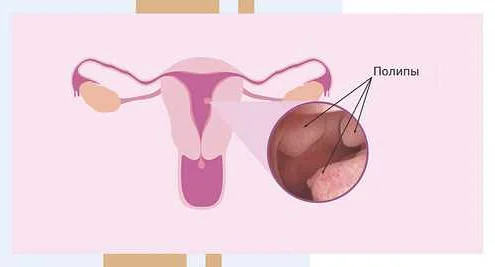Ключевые анализы для диагностики полипа эндометрия