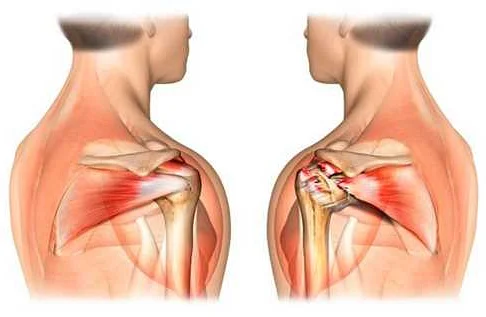 Как избежать осложнений после операции на плече