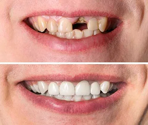 Керамические коронки защищают зубы от повреждений