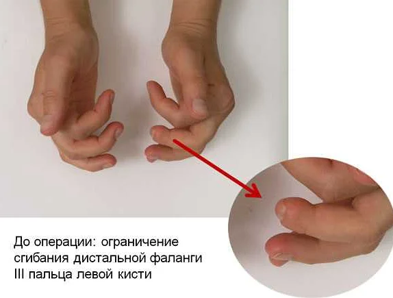 Влияние возрастных изменений на возникновение новообразования в верхней фаланге мизинца на руке