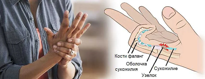 Травматический фактор как причина новообразования в верхней фаланге мизинца на руке