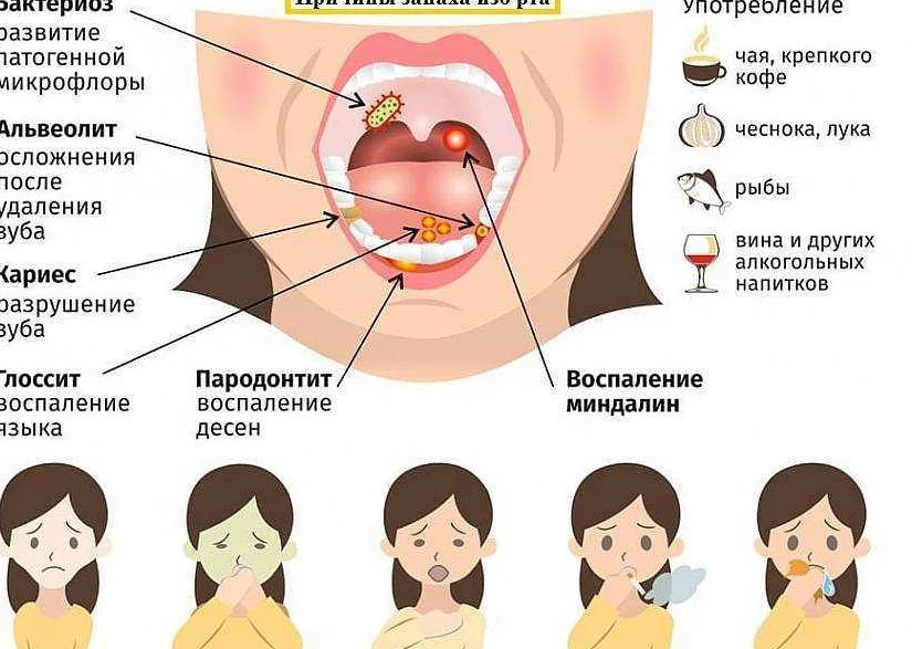 Причины появления запаха ацетона изо рта