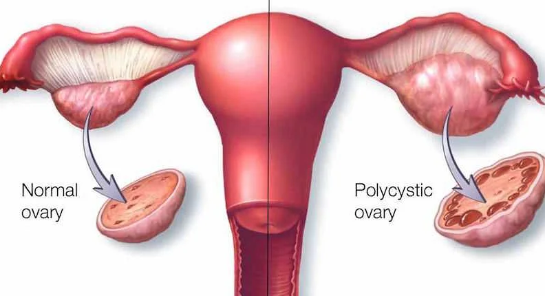 Мониторинг беременности при поликистозной трансформации яичников