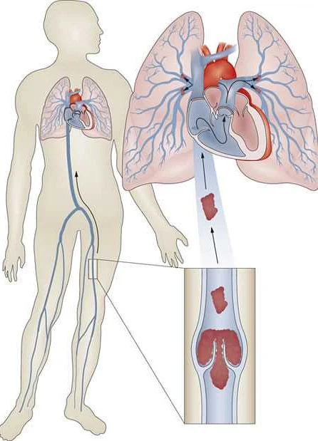 Причины развития тромбоэмболии мелких ветвей легочной артерии