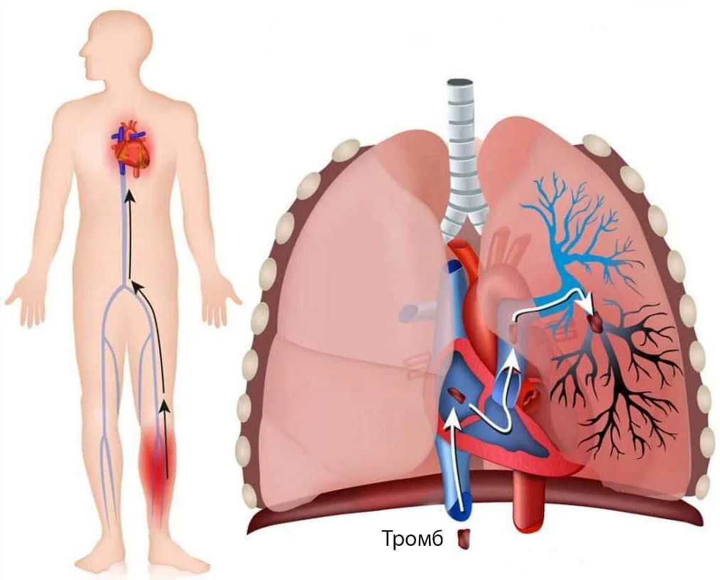 Какие симптомы сопутствуют тромбоэмболии мелких ветвей легочной артерии?
