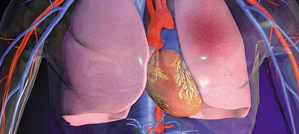 Как проводится лечение тромбоэмболии мелких ветвей легочной артерии?
