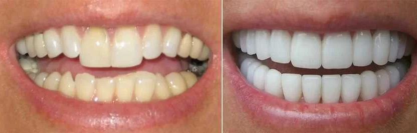 Коррекция зубов без боли